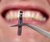 dental implant procedure wheaton il
