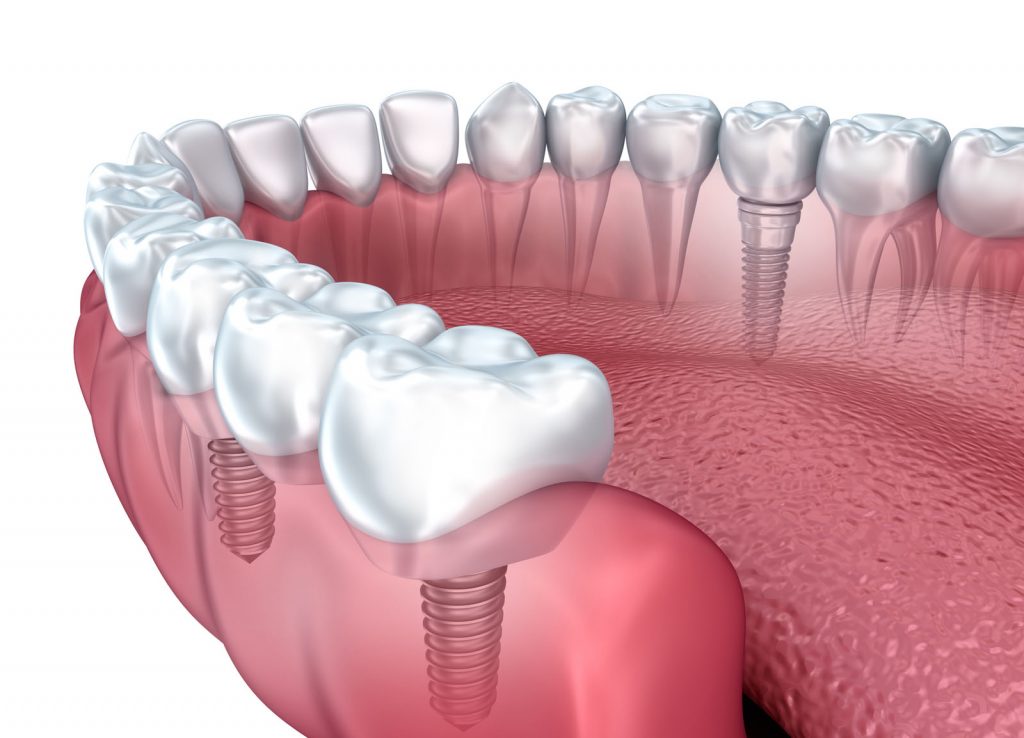 Dental implants quincy